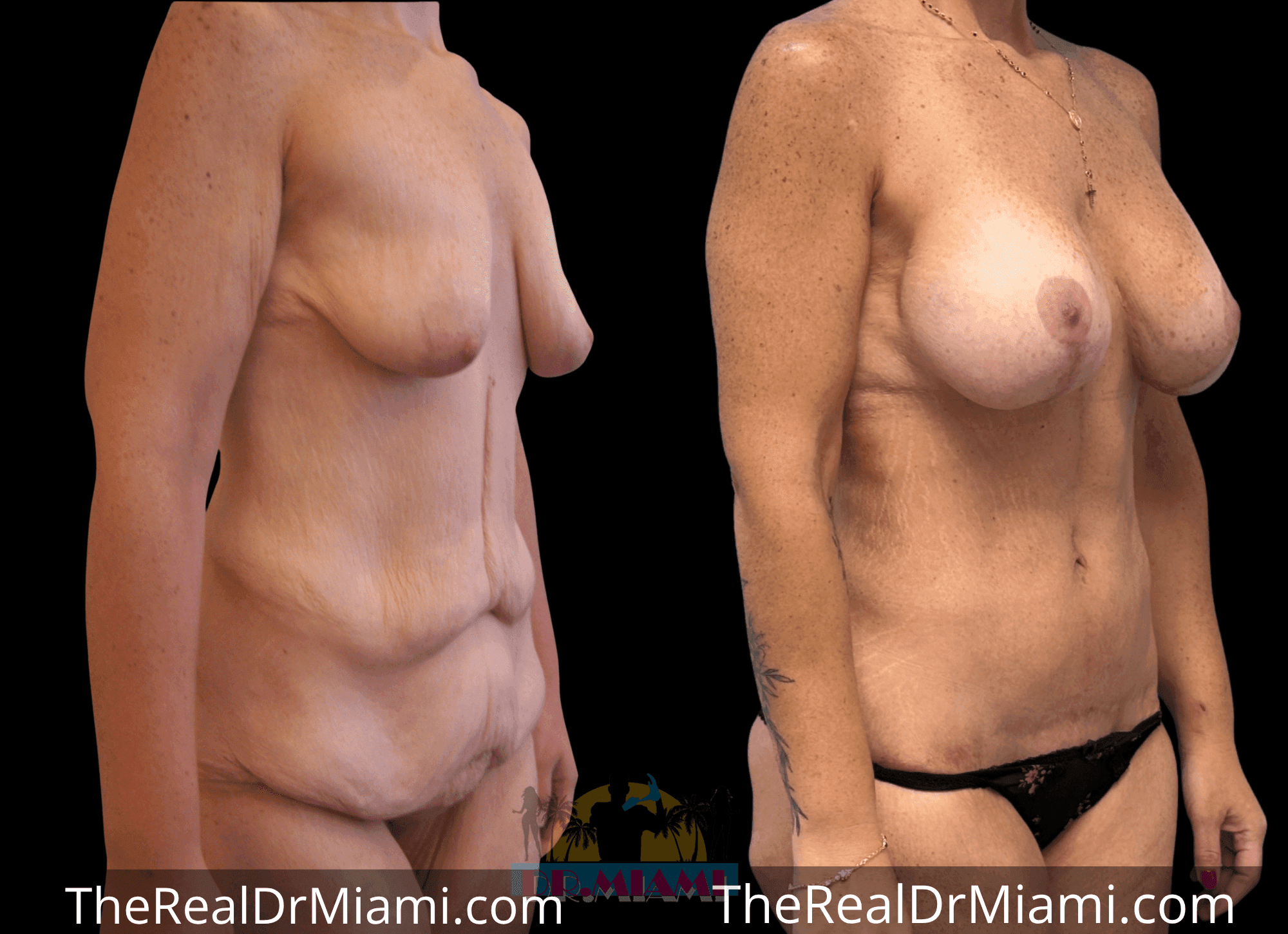 Before-and-after views for Massive Weight Loss, Case 18.