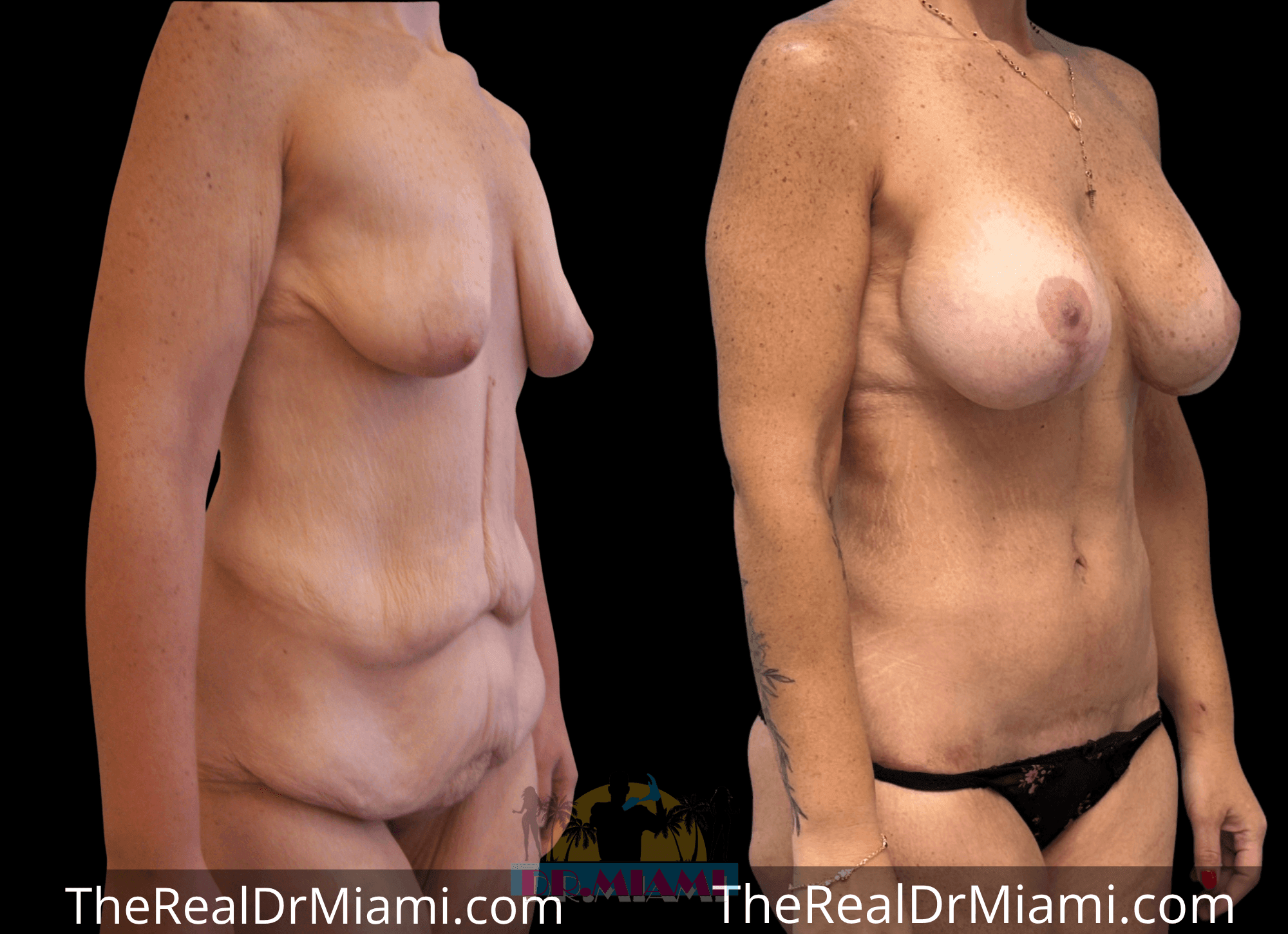 Before-and-after views for Massive Weight Loss, Case 18.