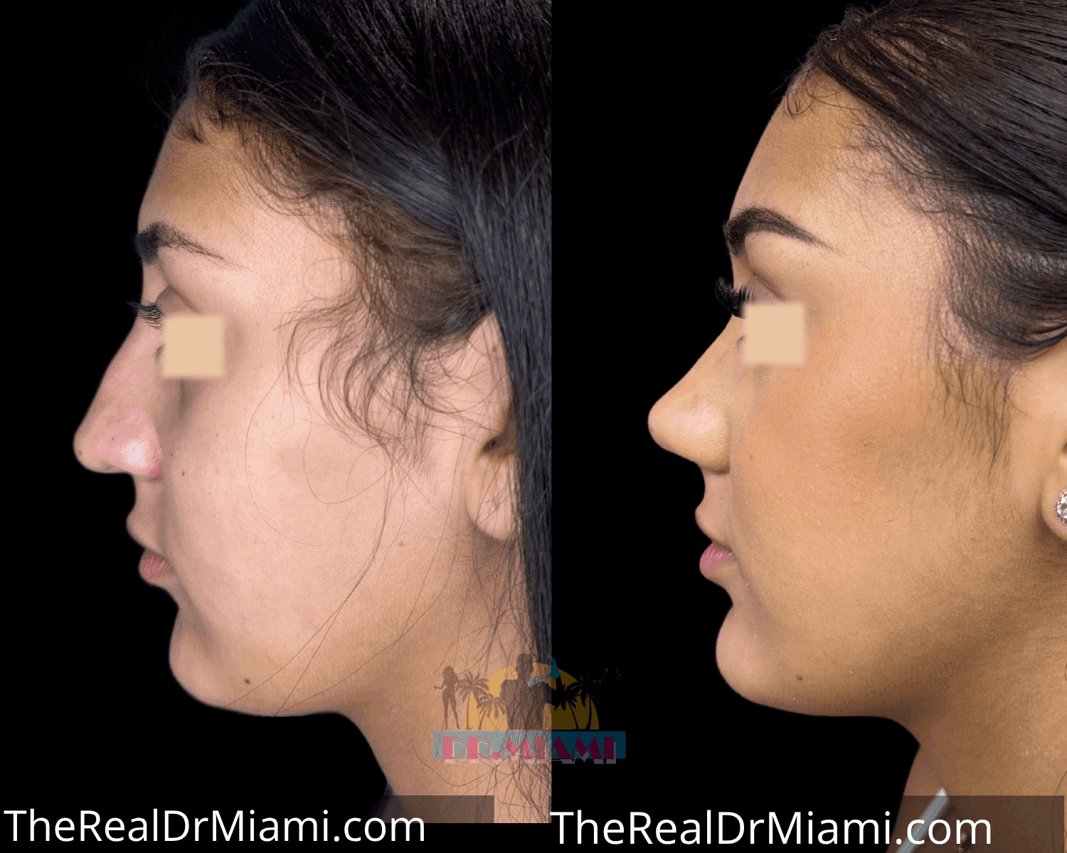 Before-and-after views for Rhinoplasty, Case 16.