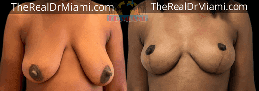 Before-and-after views for Breast Lift, Case 10.