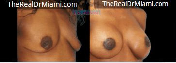 Before-and-after views for Breast Augmentation, Case 24.