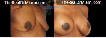 Before-and-after views for Breast Augmentation, Case 24.