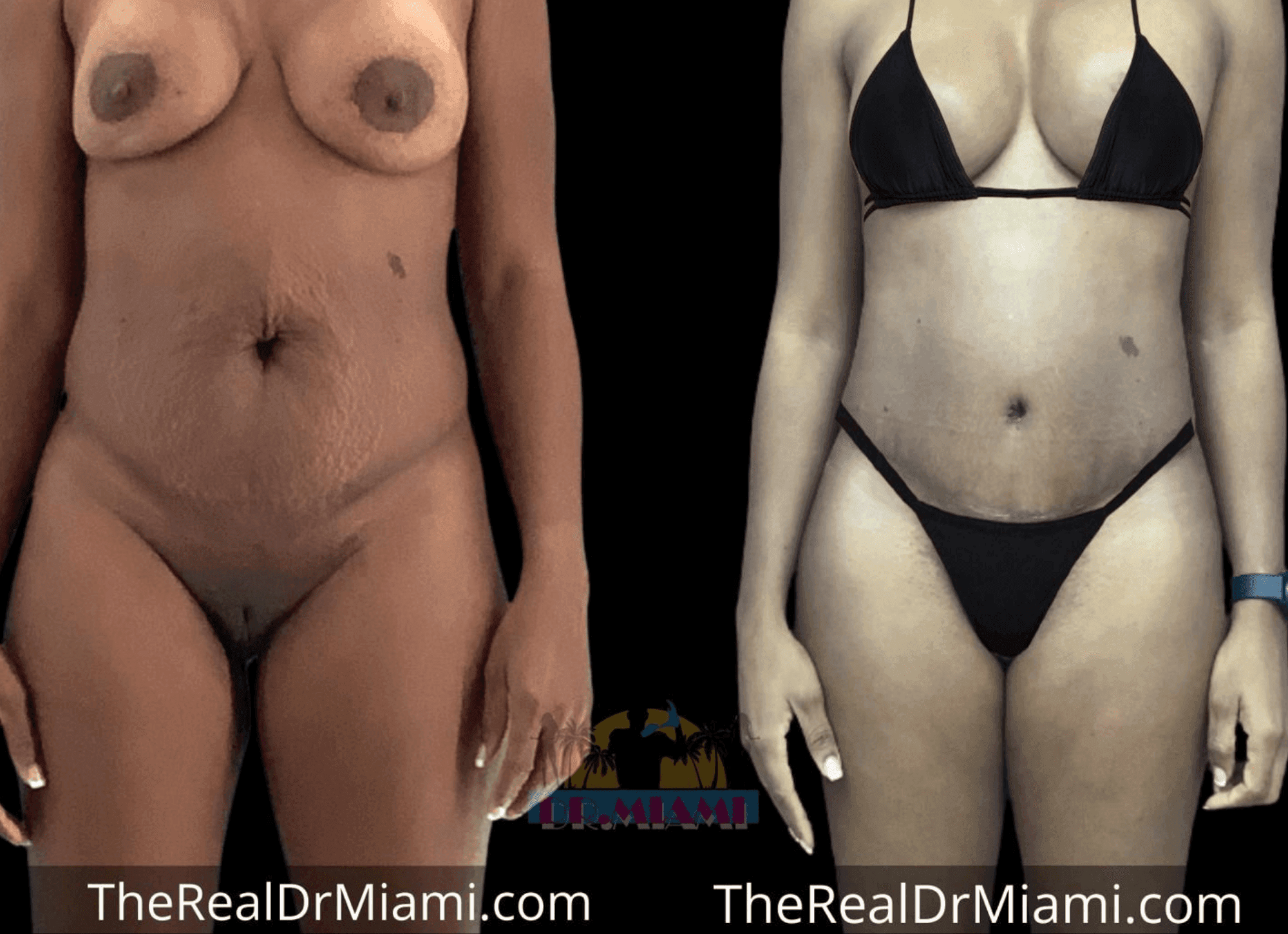 Before-and-after views for Mommy Makeover, Case 63.