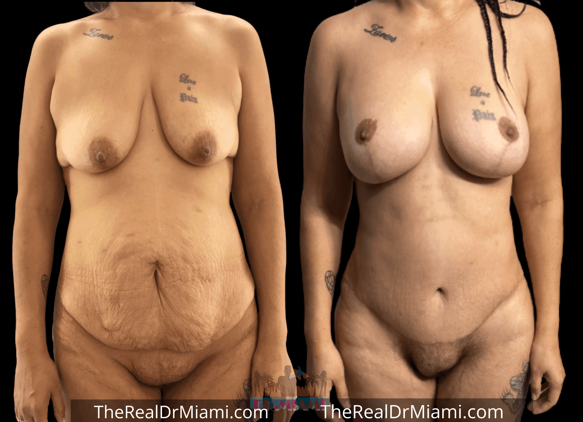 Before-and-after views for Mommy Makeover, Case 9.