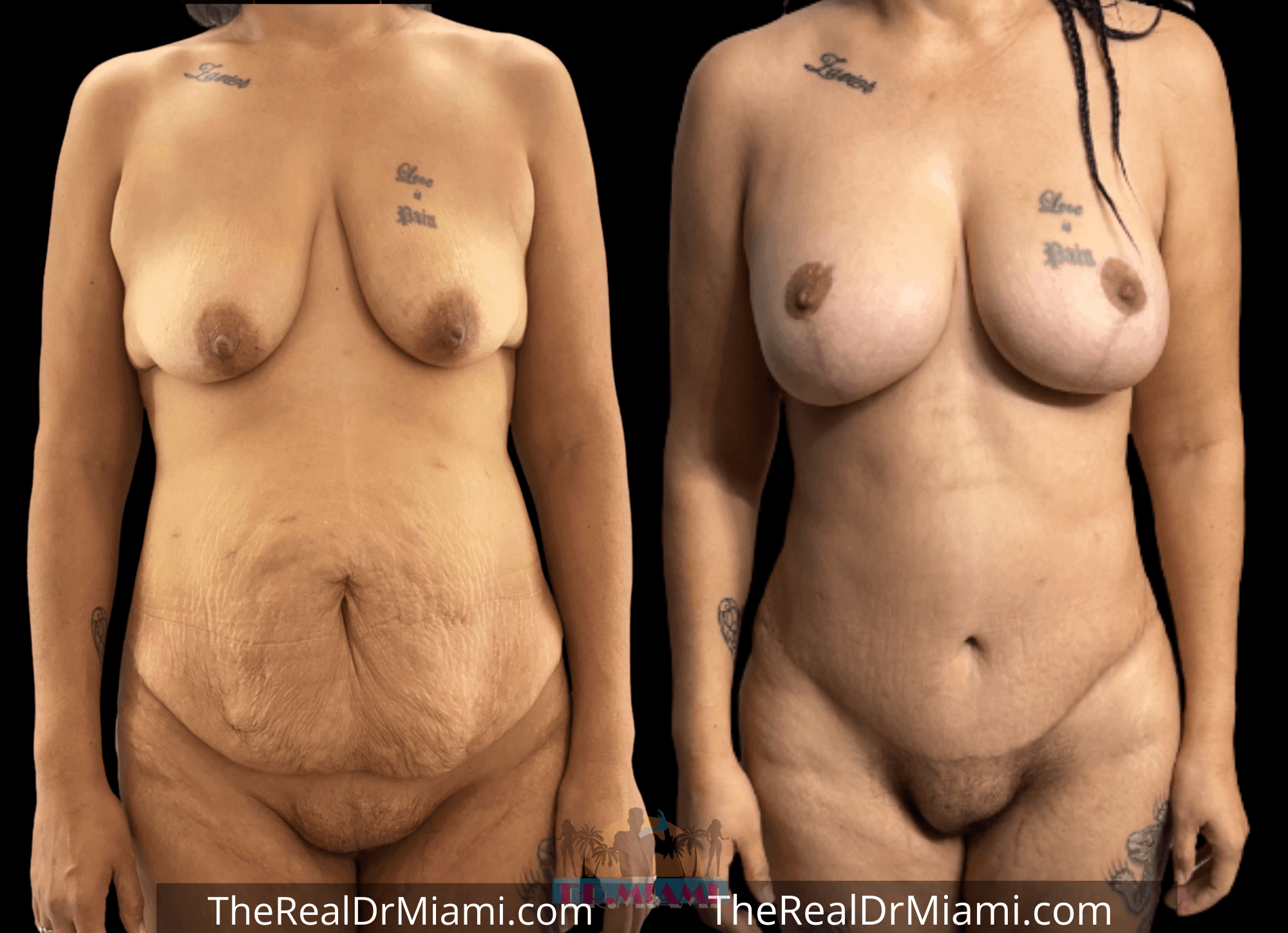 Before-and-after views for Mommy Makeover, Case 9.