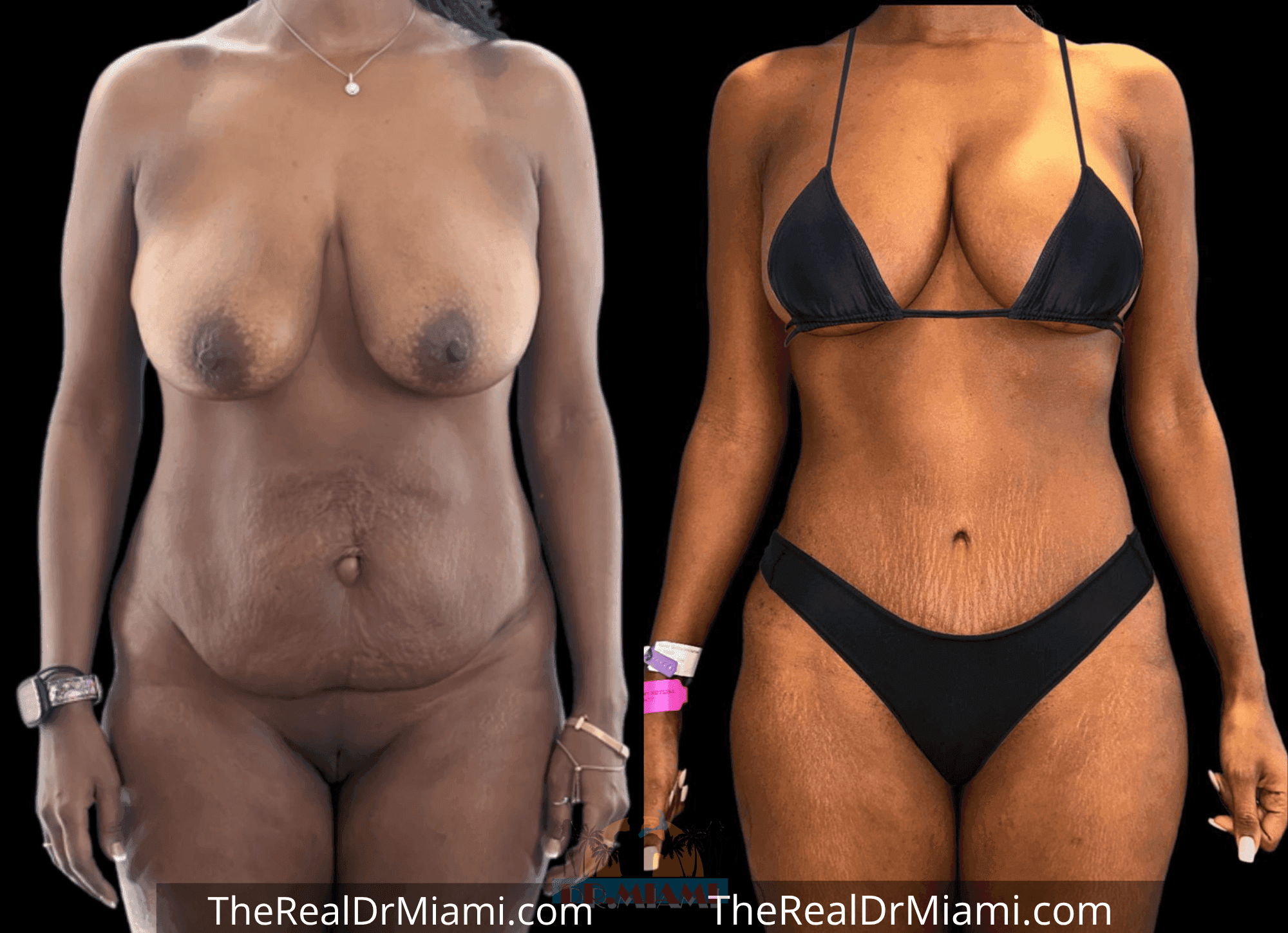 Before-and-after views for Tummy Tuck, Case 52.