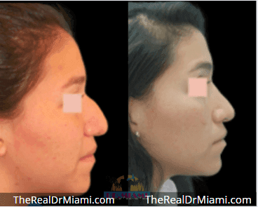 Before-and-after views for Rhinoplasty, Case 68.