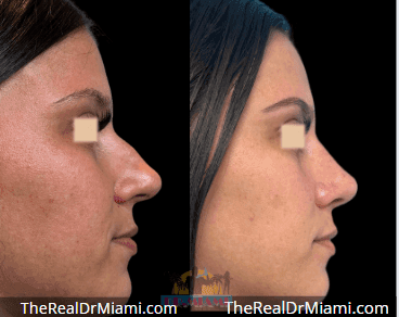 Before-and-after views for Rhinoplasty, Case 125.