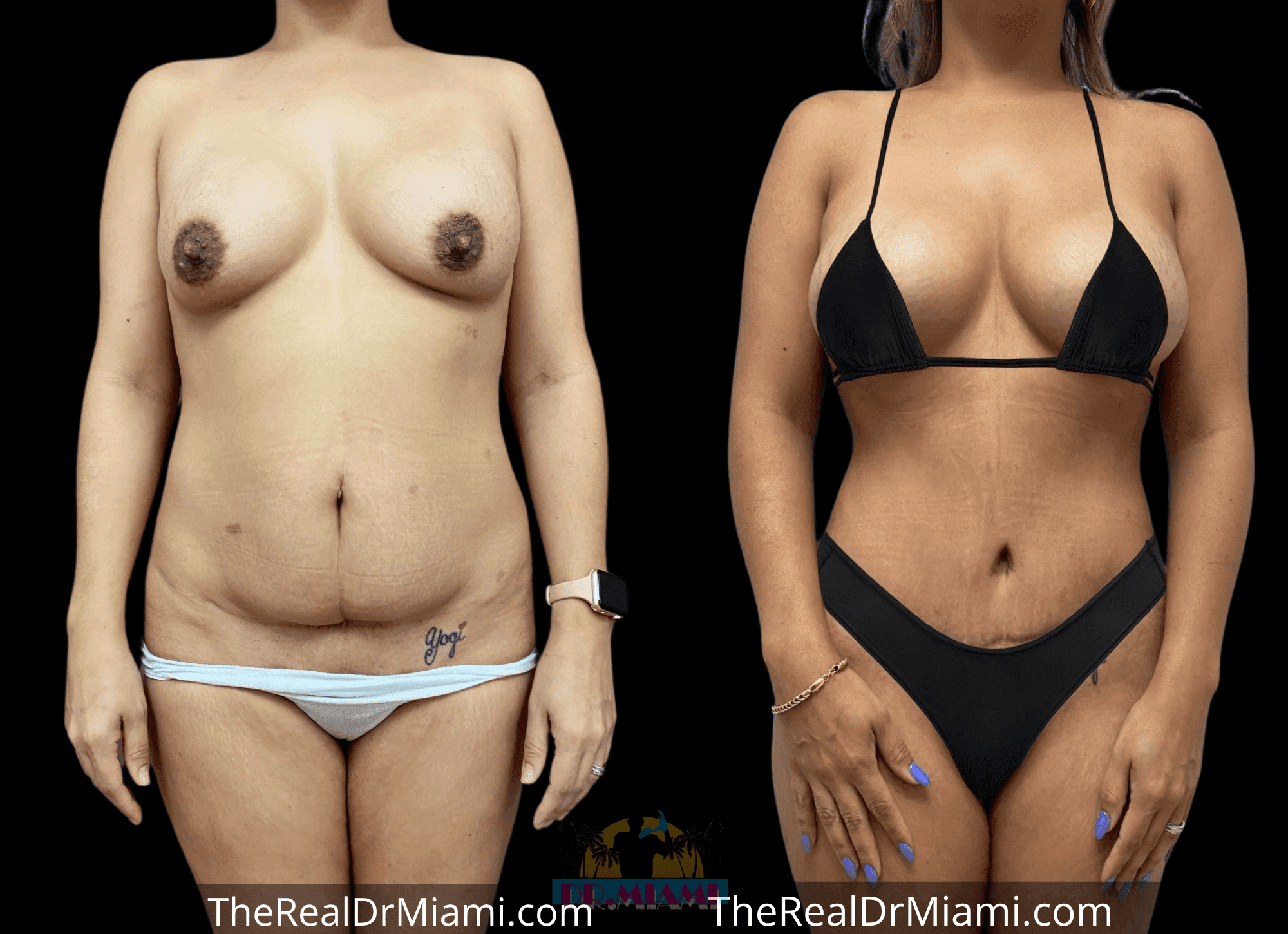 Before-and-after views for Tummy Tuck, Case 56.