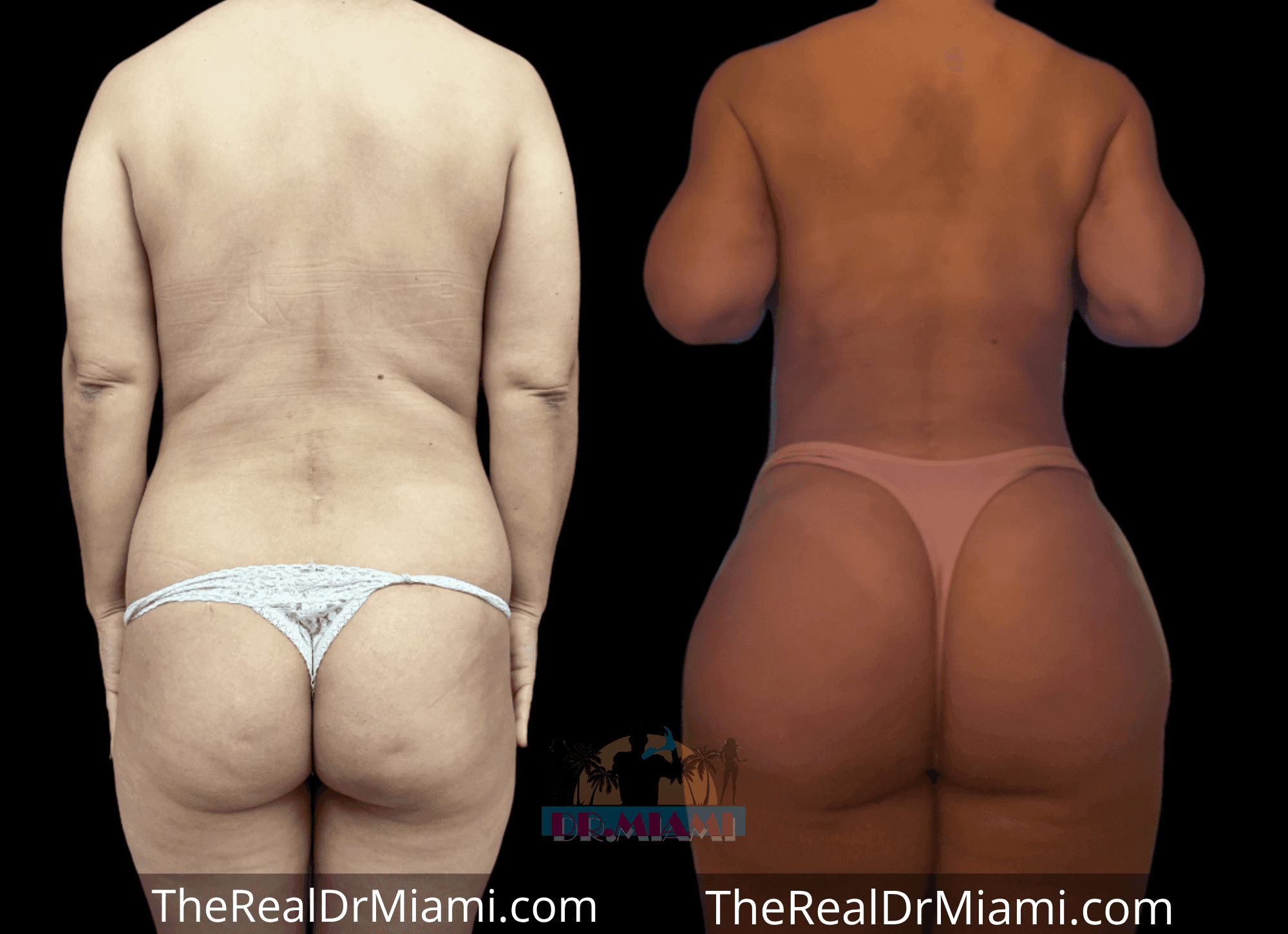 Before-and-after views for Brazilian Butt Lift, Case 106.