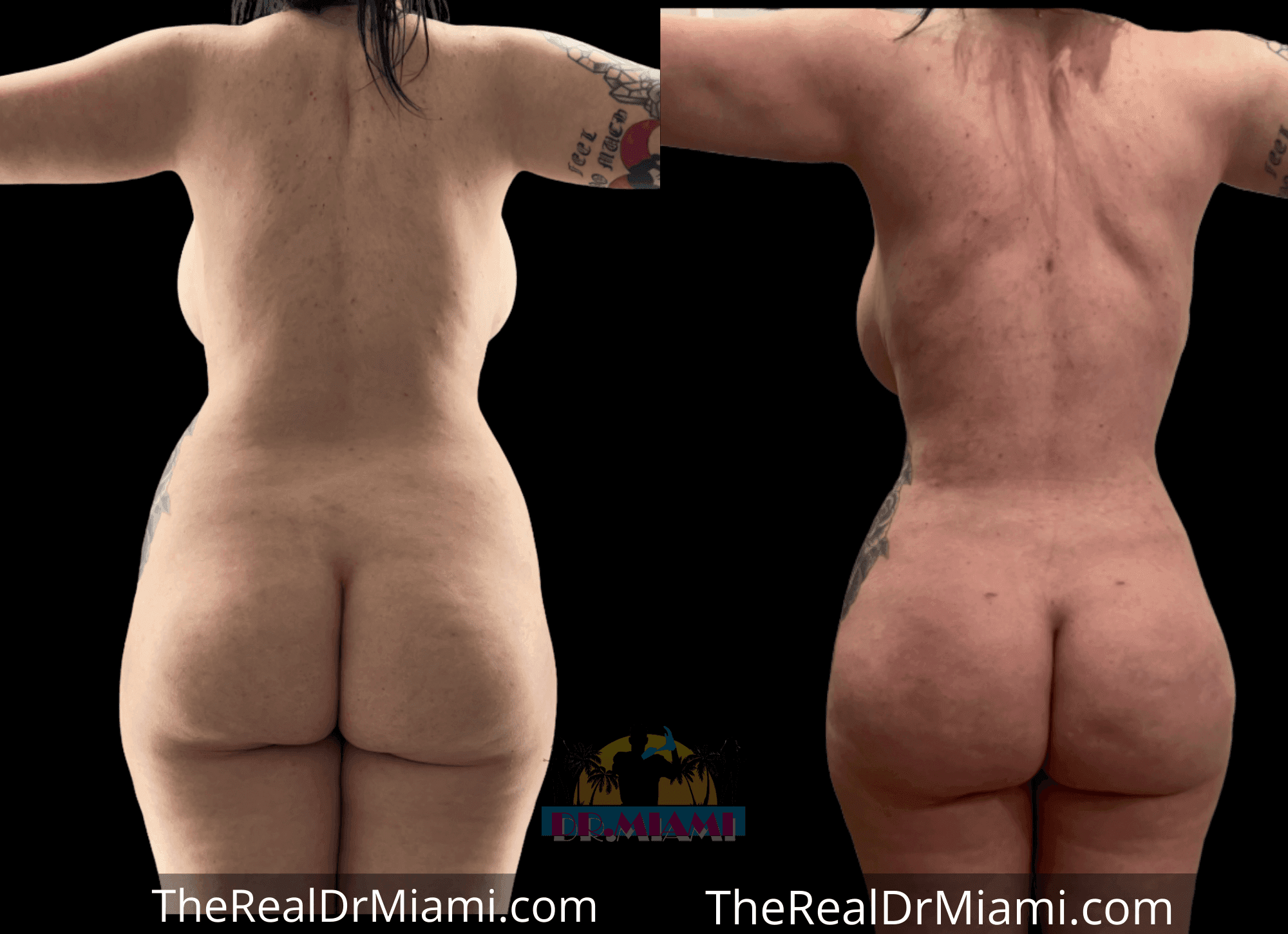 Before-and-after views for Brazilian Butt Lift, Case 28.