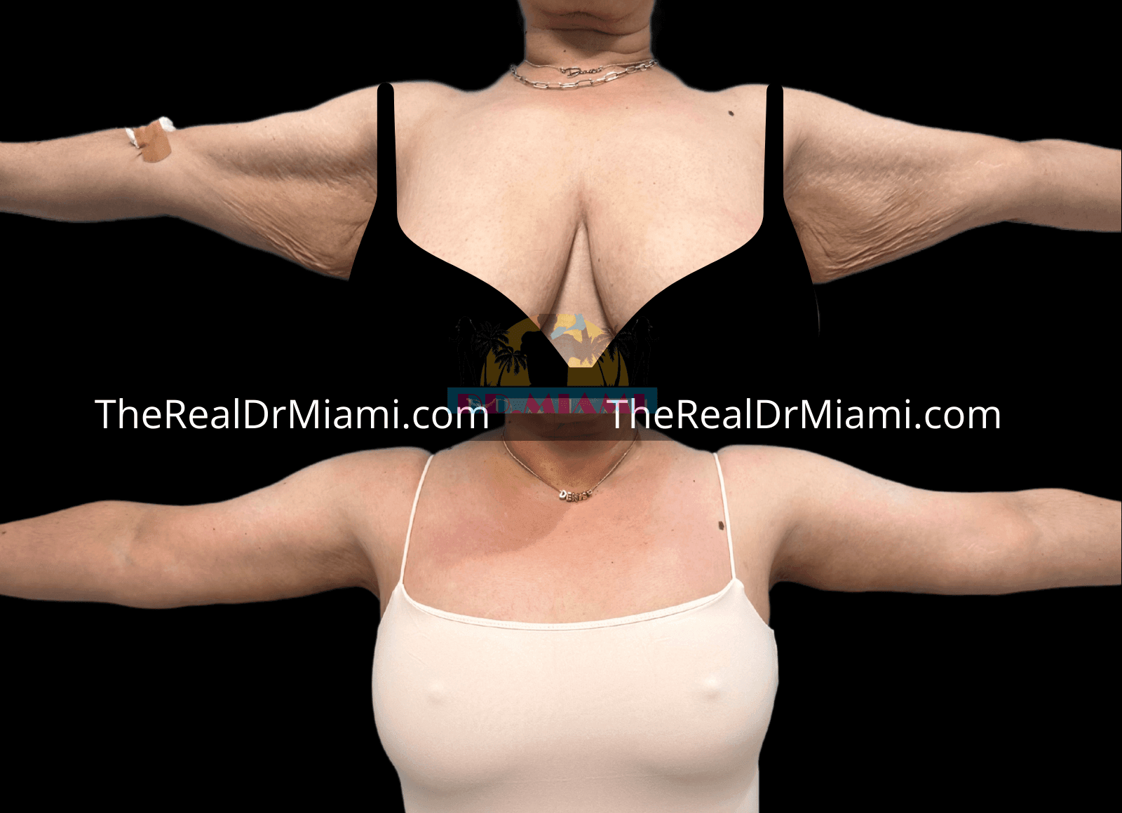 Before-and-after views for Upper Arm Lift, Case 1.