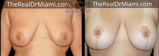 Before-and-after views for Breast Lift, Case 44.