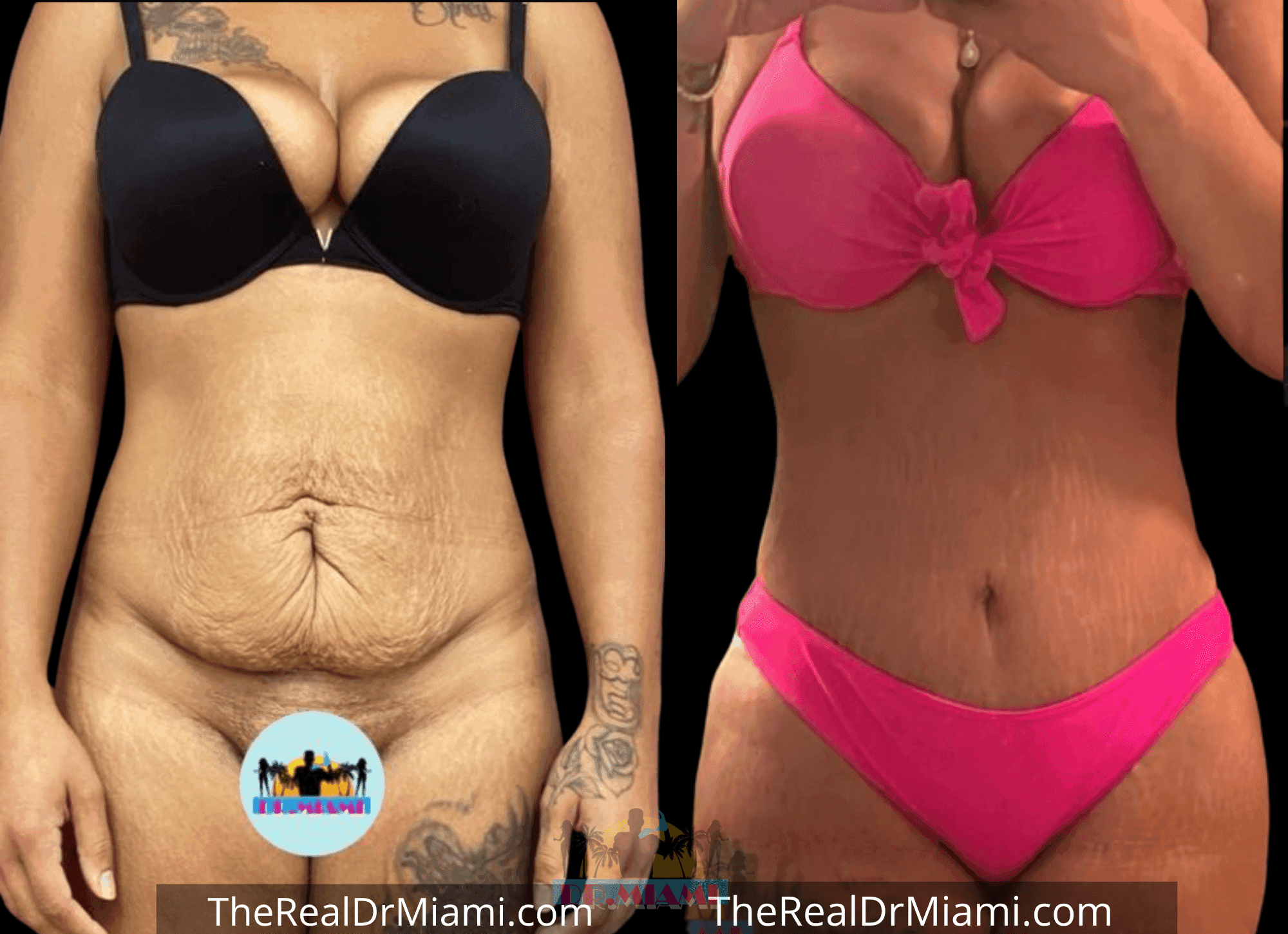 Before-and-after views for Tummy Tuck, Case 68.