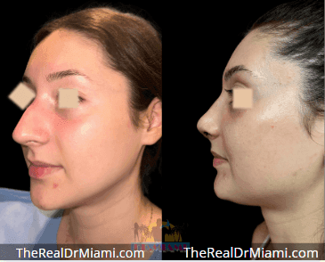 Before-and-after views for Rhinoplasty, Case 120.