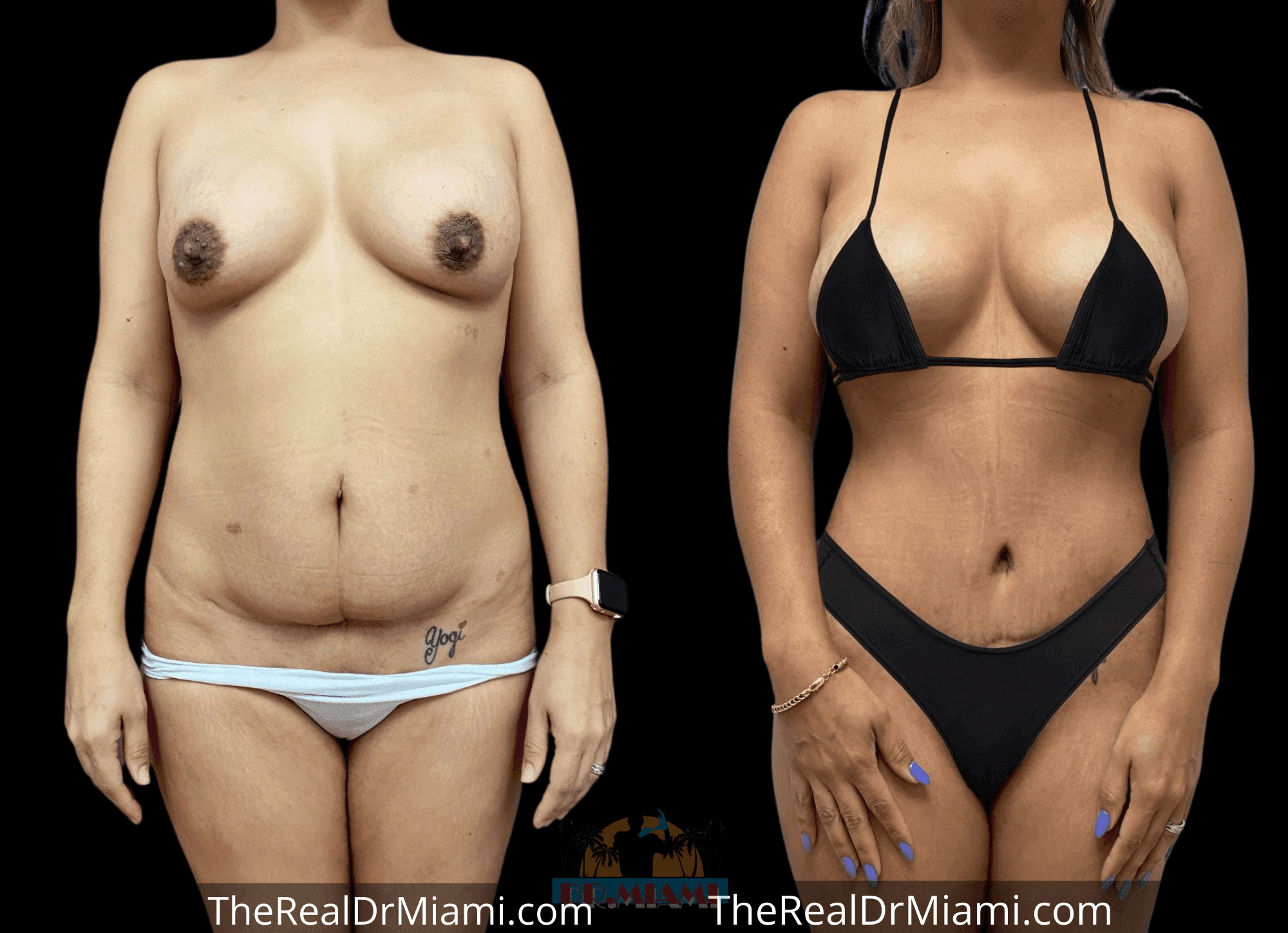 Before-and-after views for Mommy Makeover, Case 94.