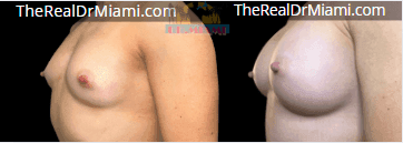 Before-and-after views for Breast Augmentation, Case 44.
