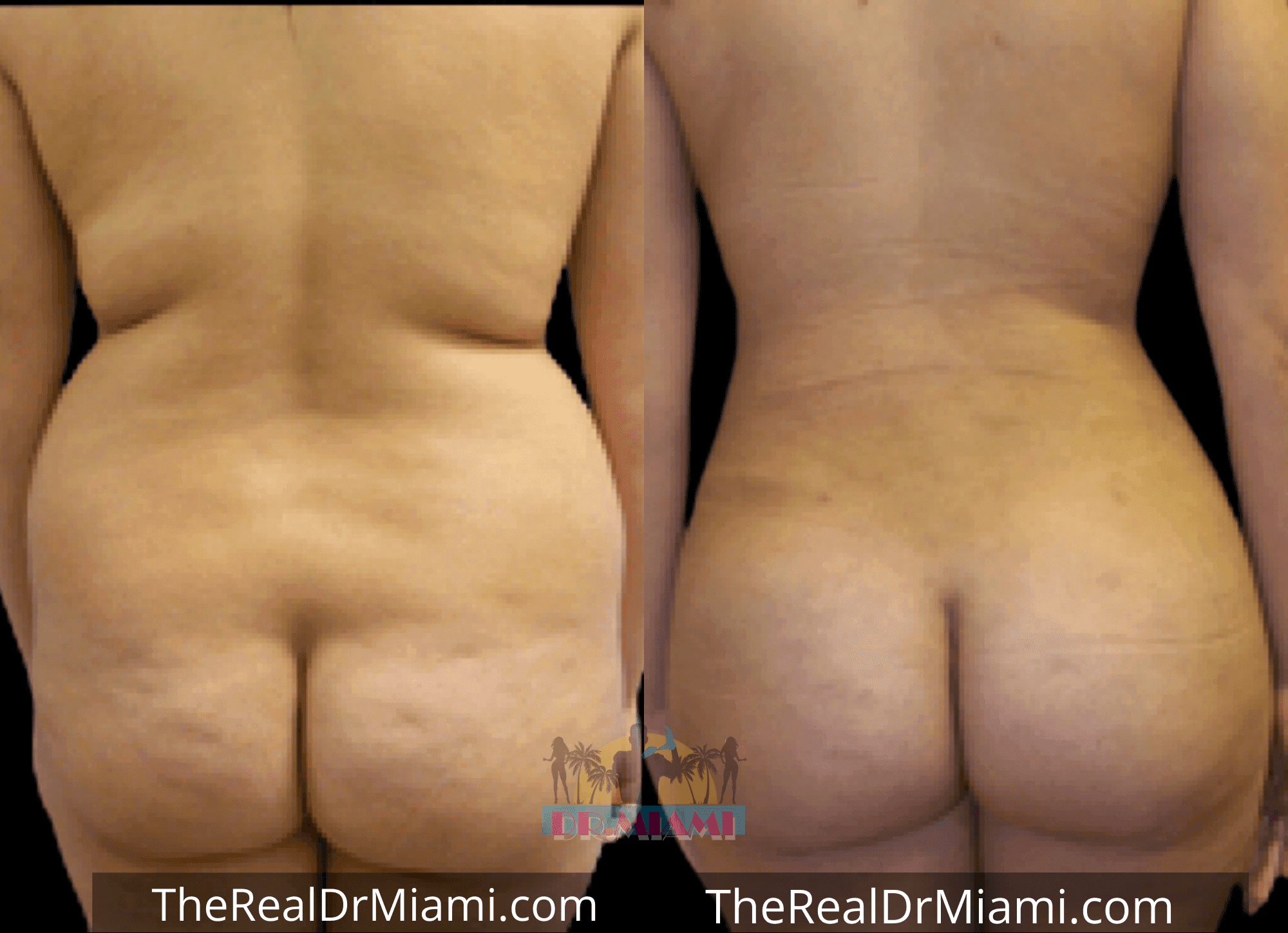 Before-and-after views for Brazilian Butt Lift, Case 95.