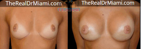 Before-and-after views for Breast Augmentation, Case 119.