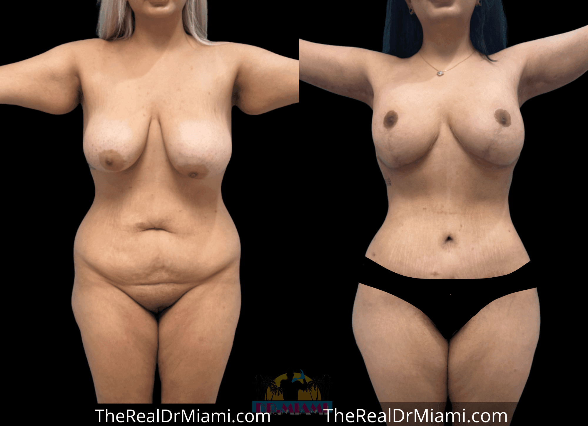 Before-and-after views for Mommy Makeover, Case 117.