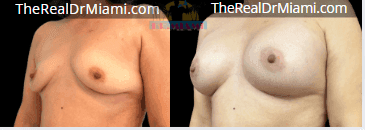 Before-and-after views for Breast Augmentation, Case 56.
