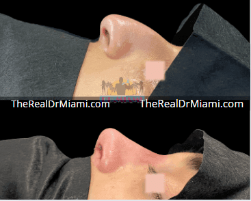 Before-and-after views for Rhinoplasty, Case 106.