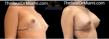 Before-and-after views for Breast Augmentation, Case 45.