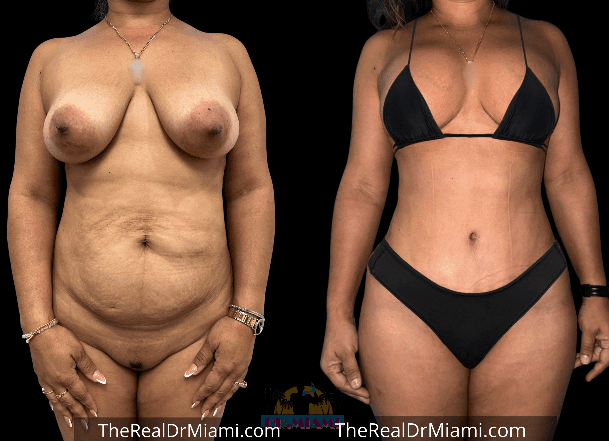 Before-and-after views for Mommy Makeover, Case 111.