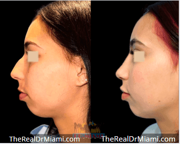 Before-and-after views for Rhinoplasty, Case 128.