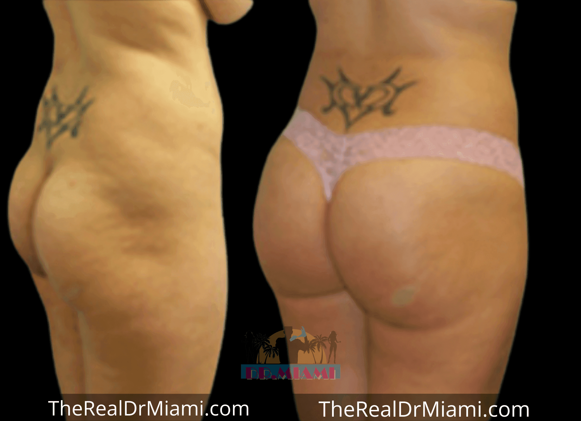 Before-and-after views for Brazilian Butt Lift, Case 48.