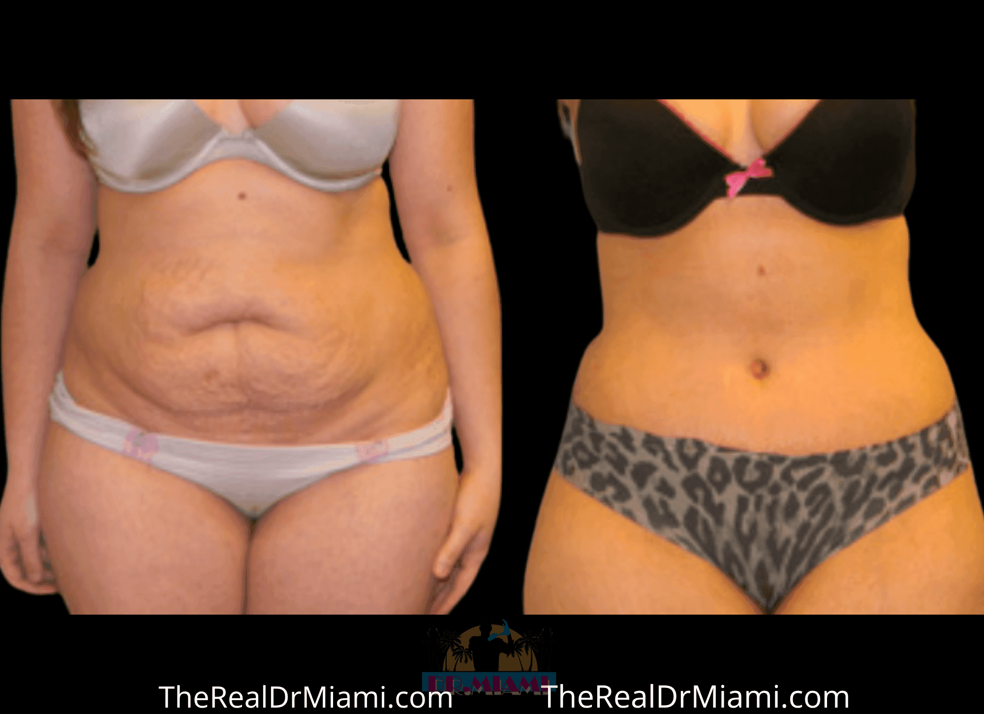 Before-and-after views for Tummy Tuck, Case 95.