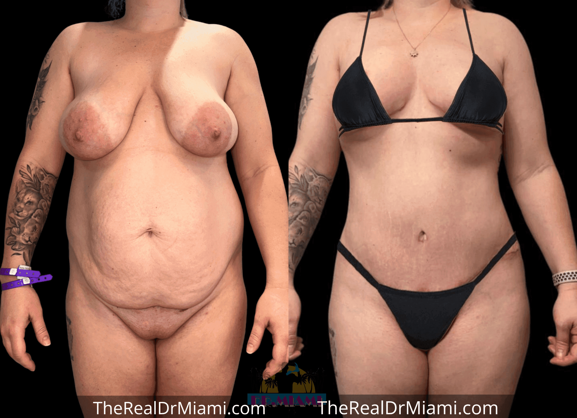 Before-and-after views for Tummy Tuck, Case 16.