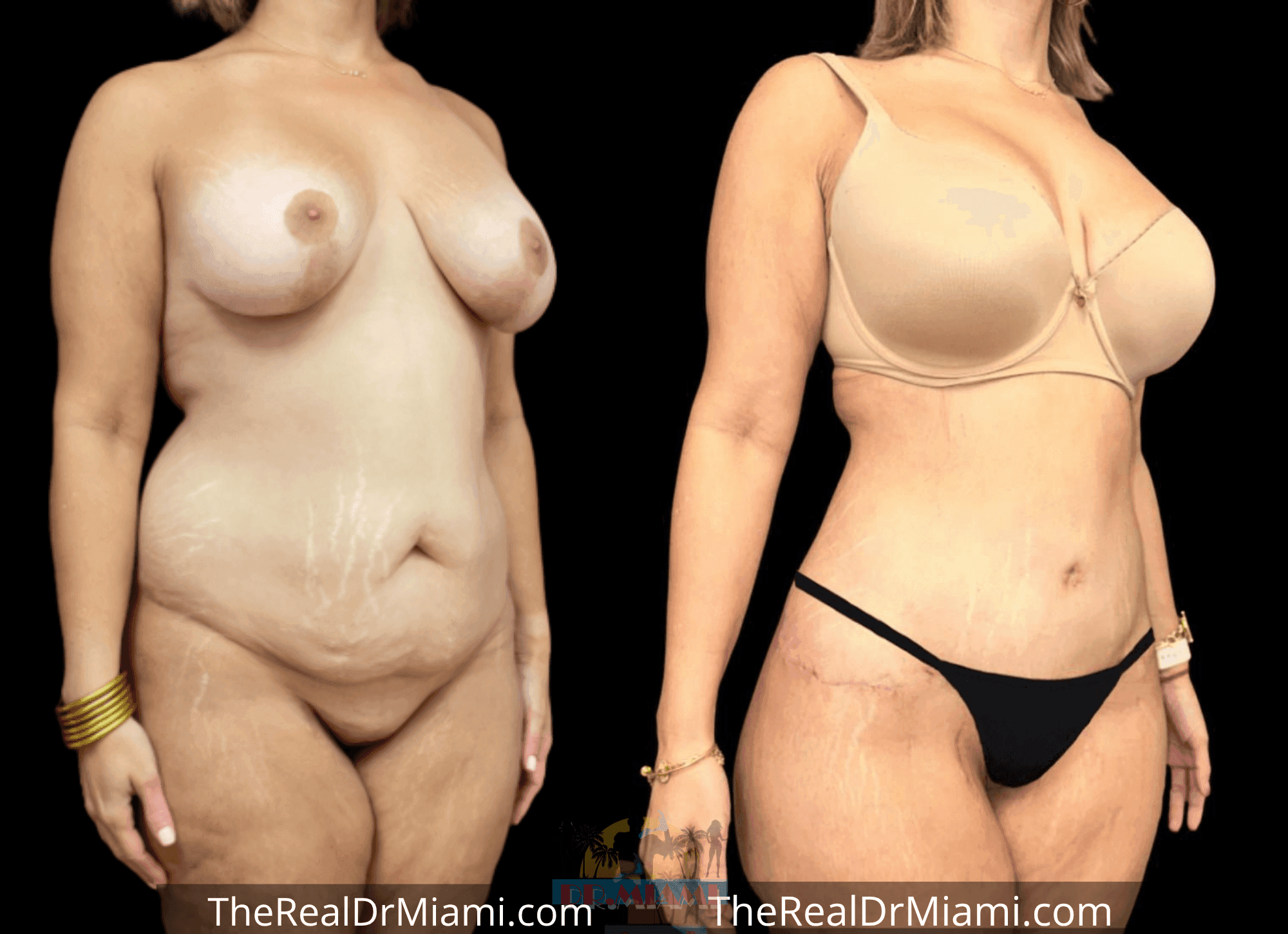 Before-and-after views for Tummy Tuck, Case 37.
