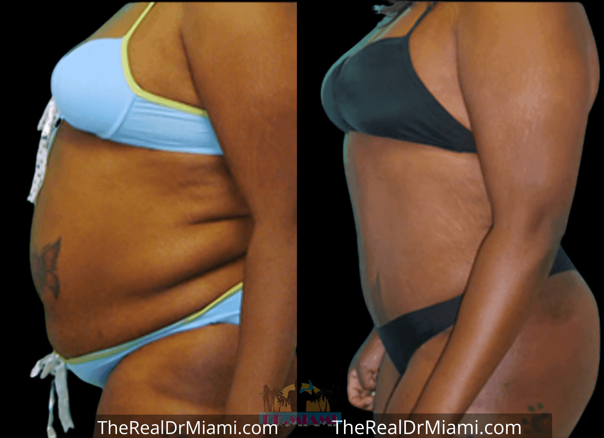 Before-and-after views for Tummy Tuck, Case 80.