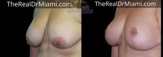 Before-and-after views for Breast Lift, Case 39.