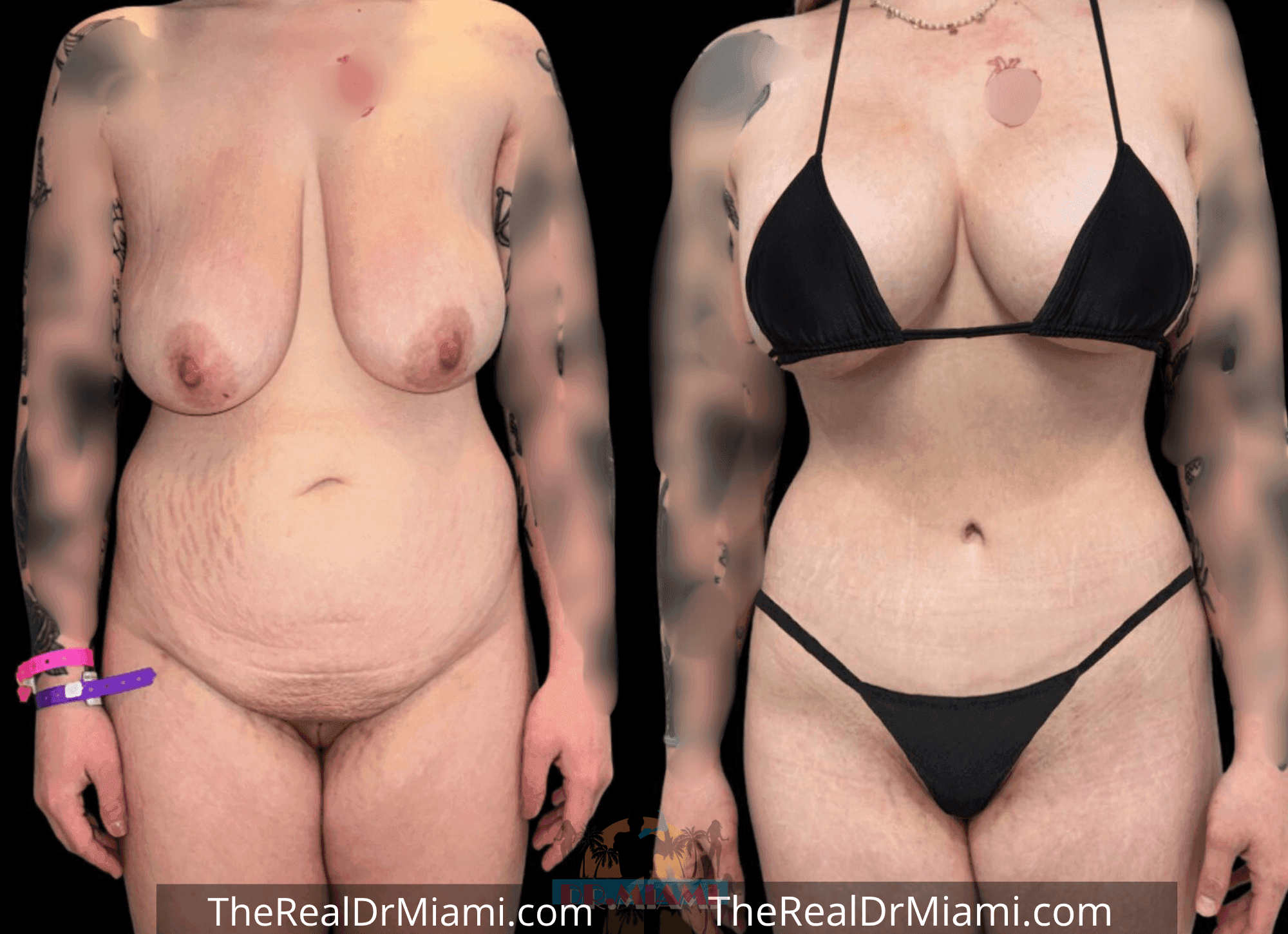 Before-and-after views for Tummy Tuck, Case 12.