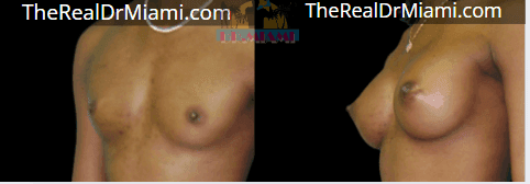 Before-and-after views for Breast Augmentation, Case 104.