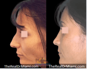 Before-and-after views for Rhinoplasty, Case 66.