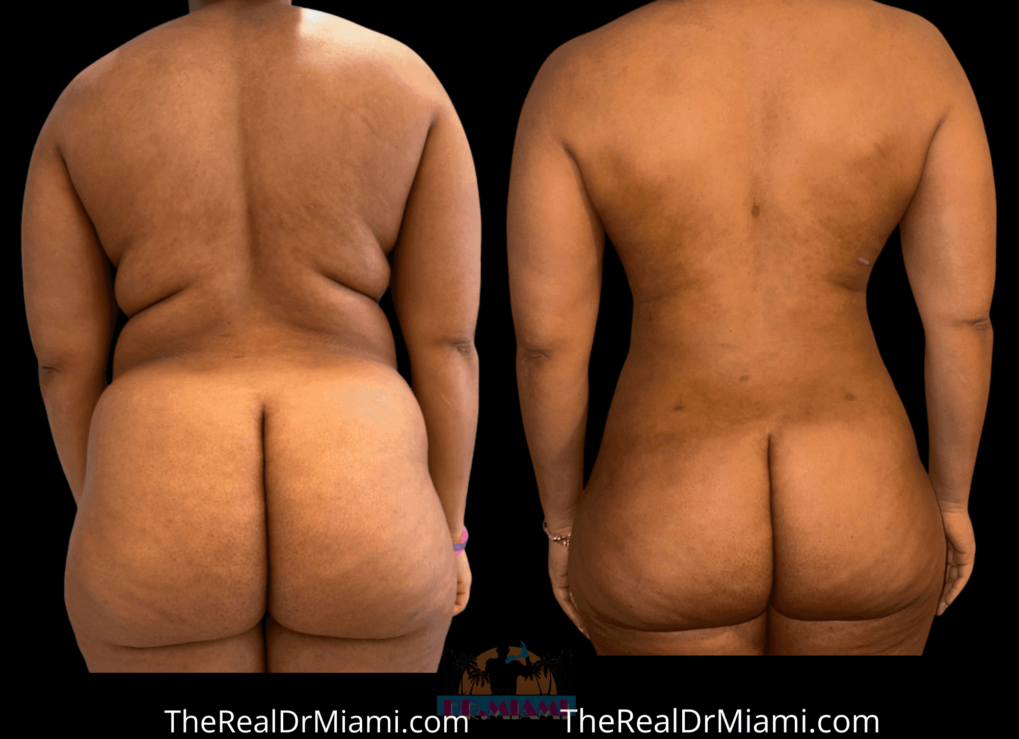 Before-and-after views for Mommy Makeover, Case 125.