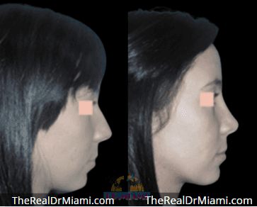 Before-and-after views for Rhinoplasty, Case 62.