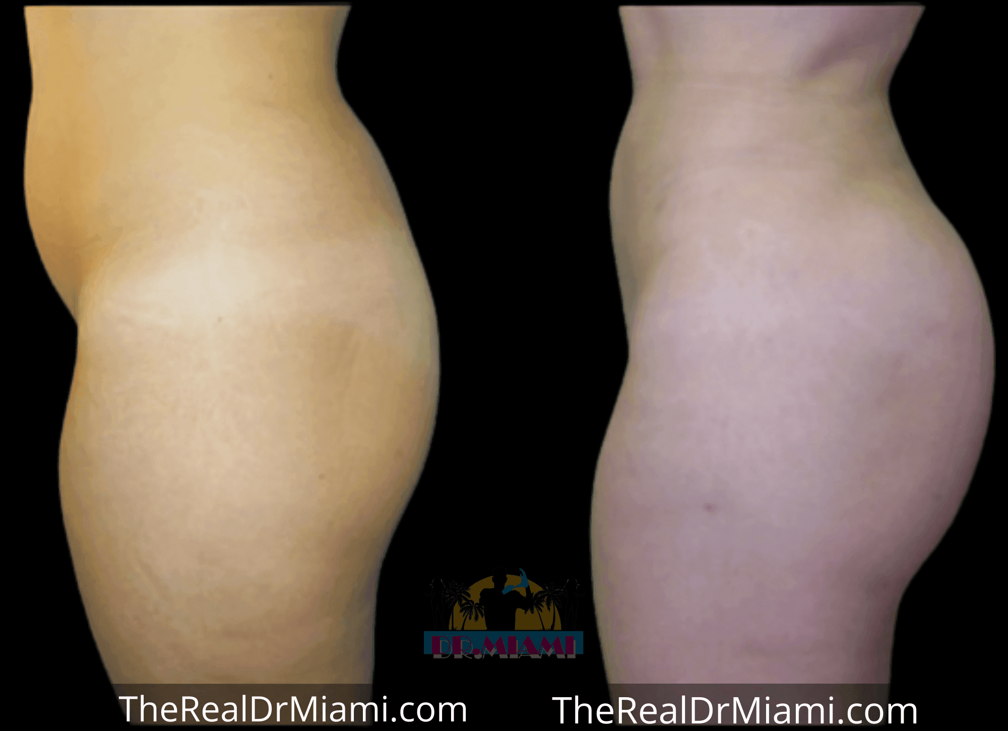 Before-and-after views for Brazilian Butt Lift, Case 58.