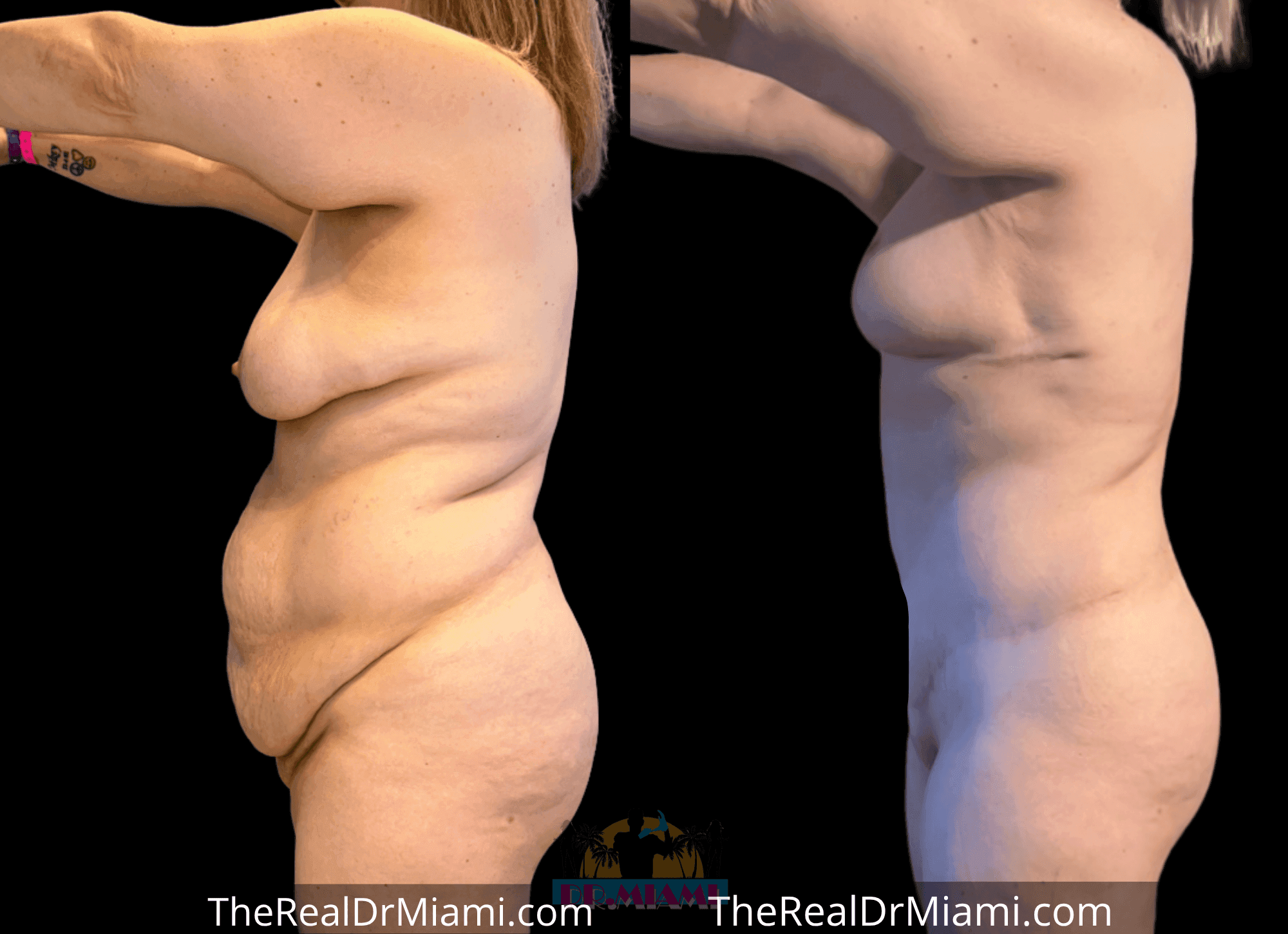 Before-and-after views for Tummy Tuck, Case 43.