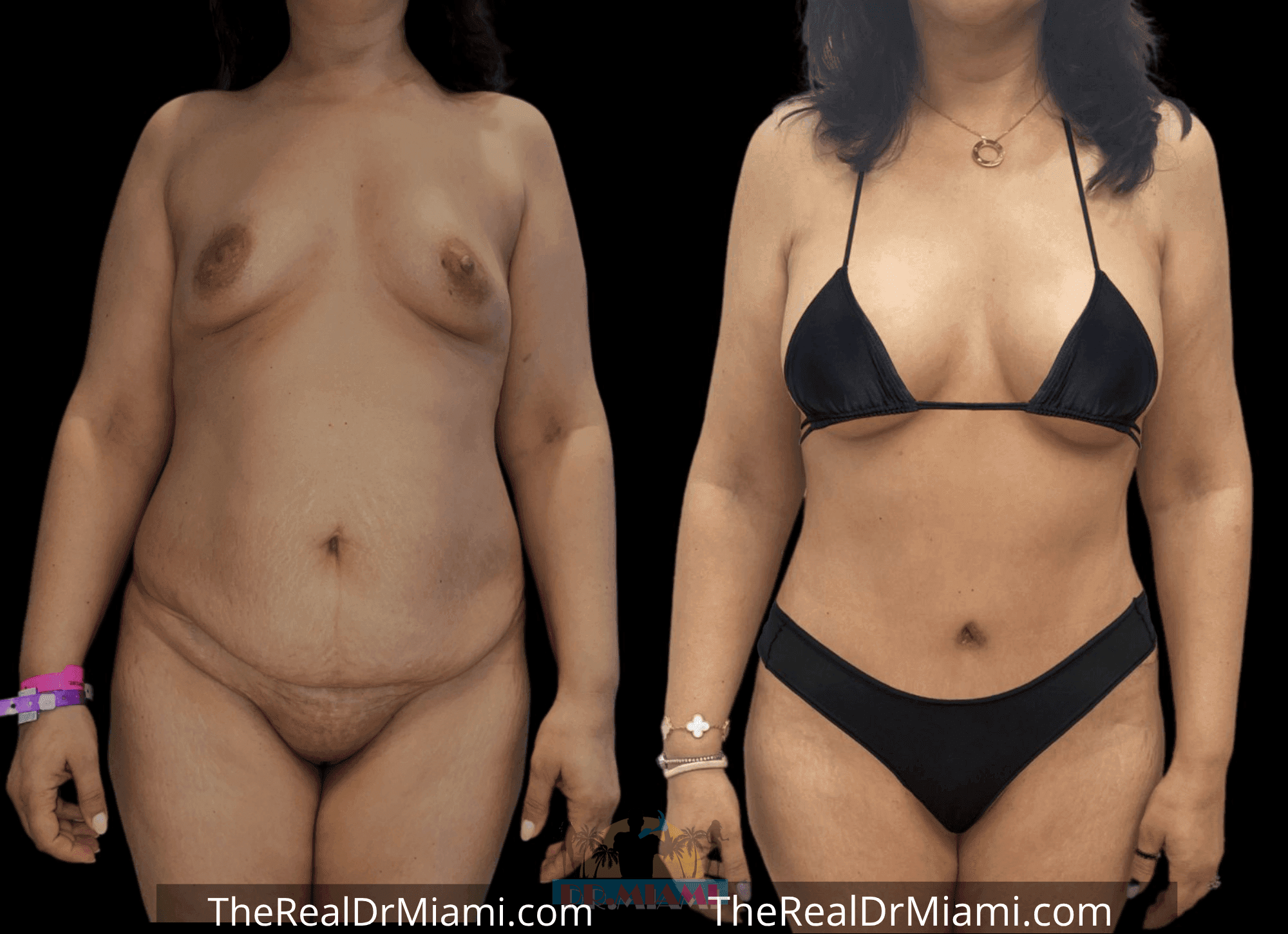 Before-and-after views for Tummy Tuck, Case 51.
