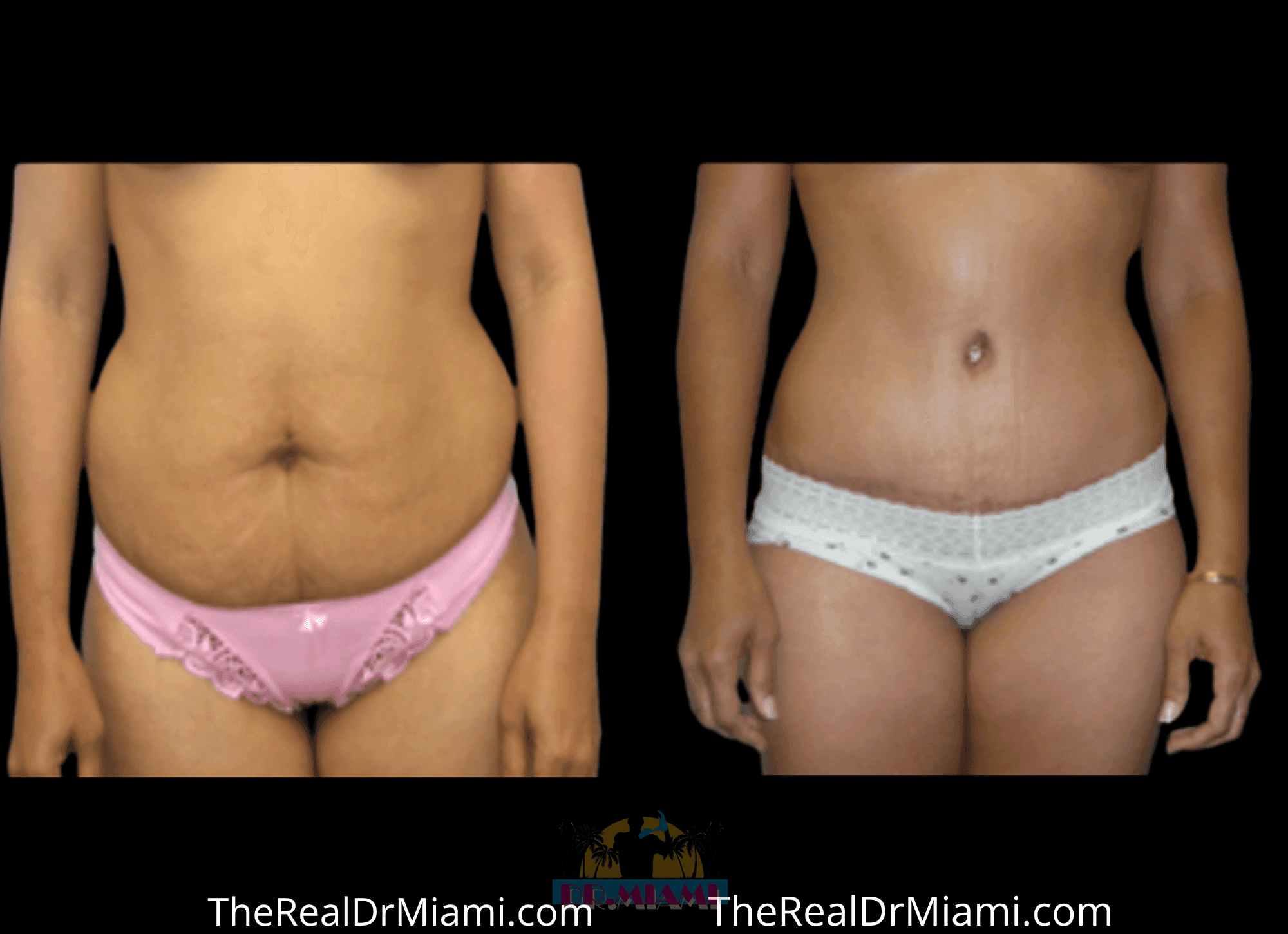 Before-and-after views for Tummy Tuck, Case 91.