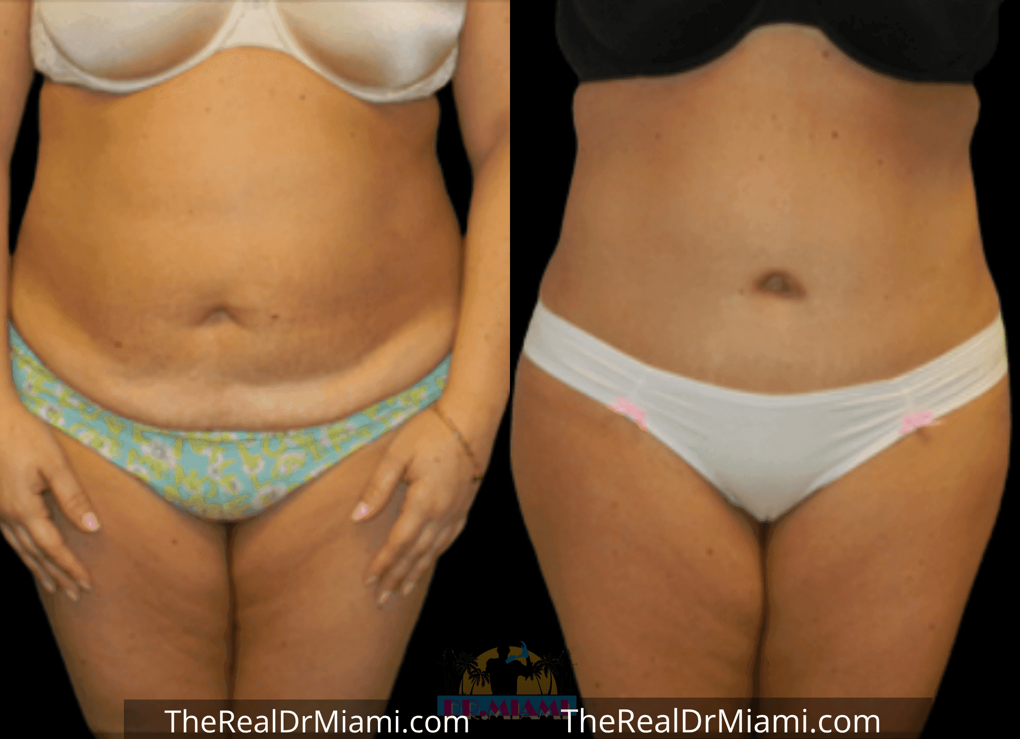 Before-and-after views for Tummy Tuck, Case 75.