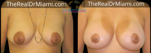 Before-and-after views for Breast Lift, Case 28.