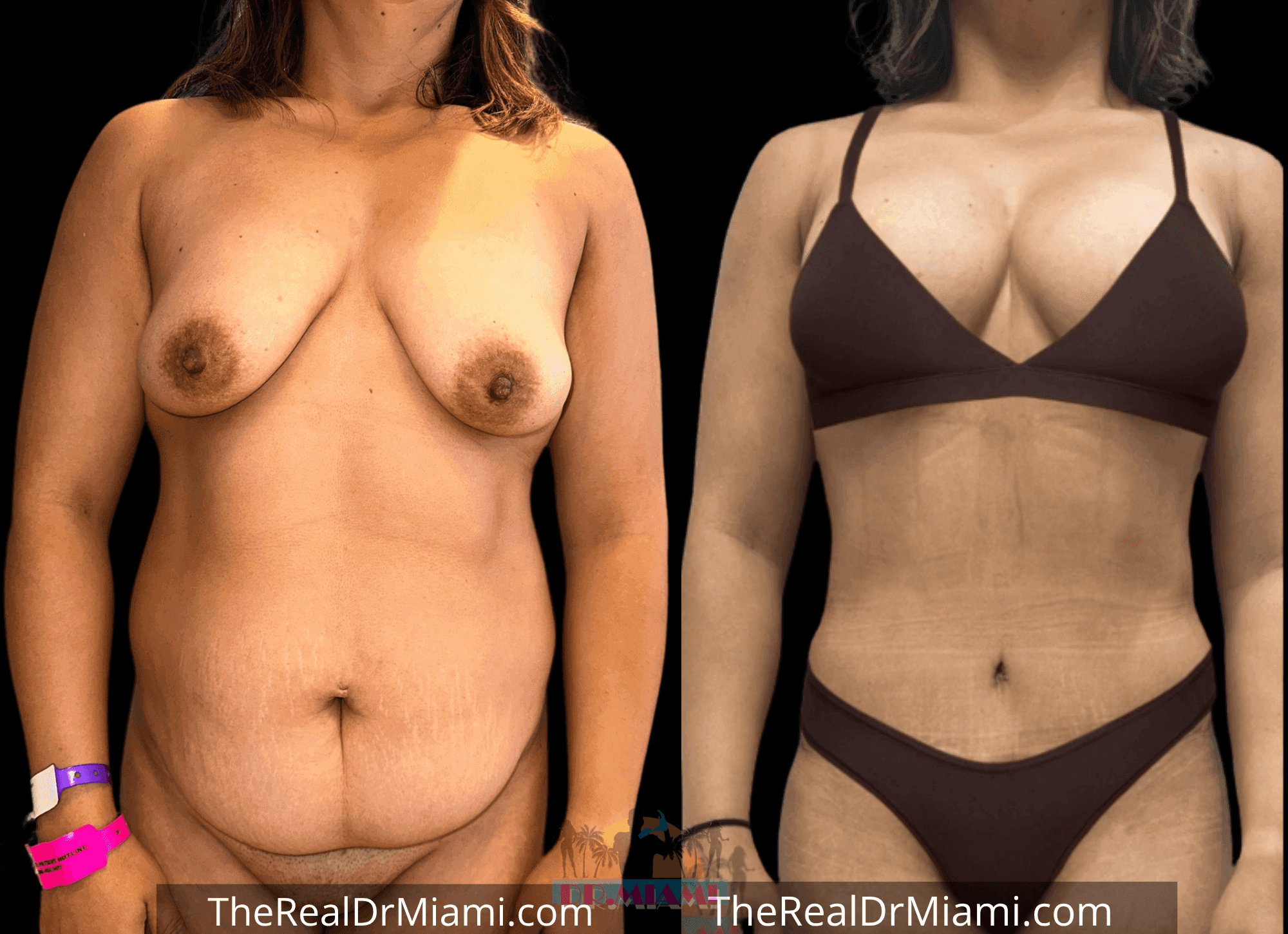 Before-and-after views for Tummy Tuck, Case 102.