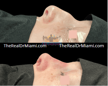 Before-and-after views for Rhinoplasty, Case 107.