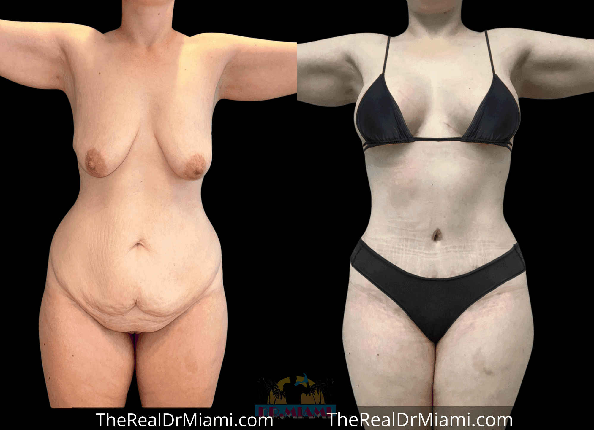 Before-and-after views for Mommy Makeover, Case 76.