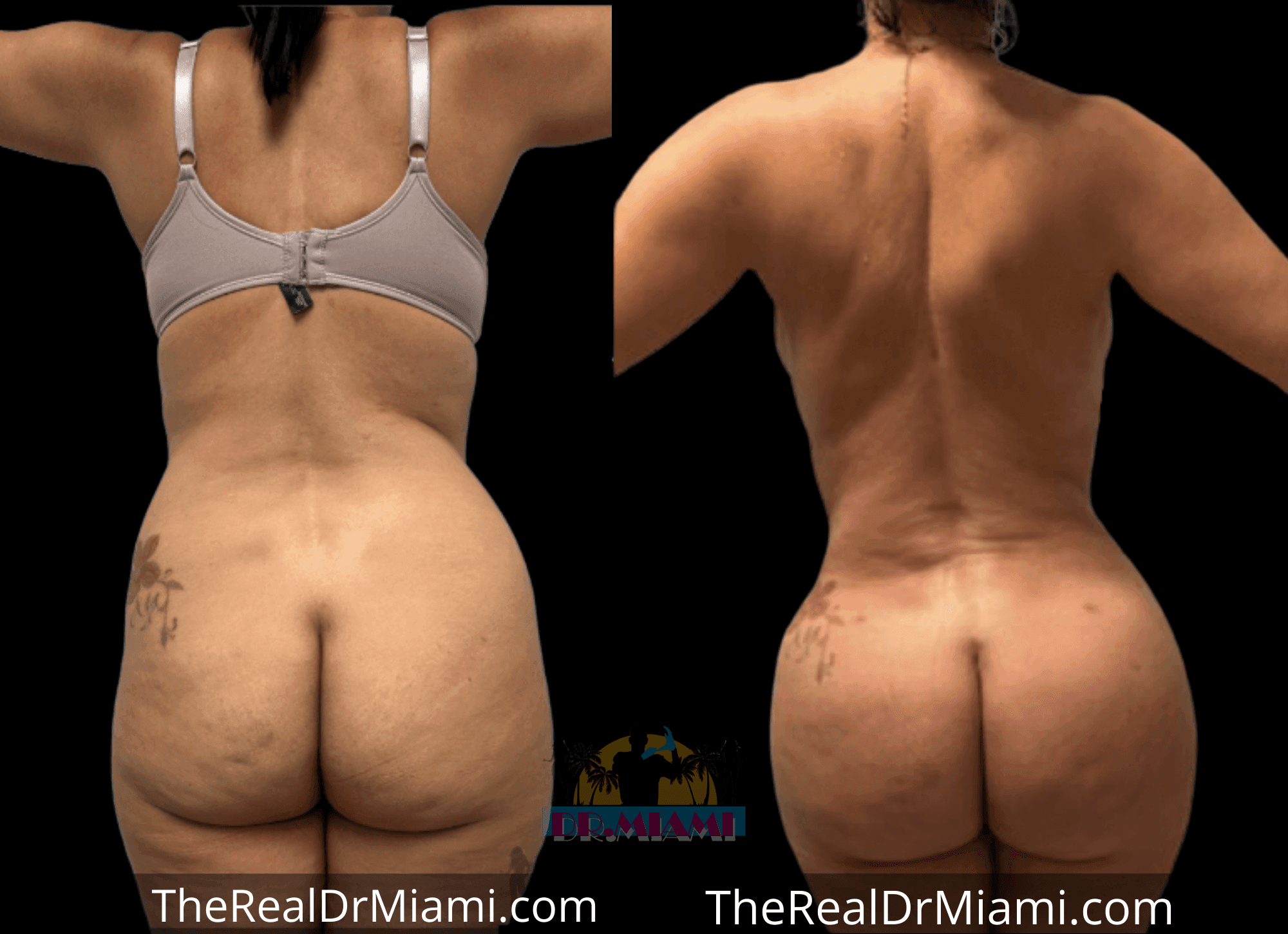 Before-and-after views for Brazilian Butt Lift, Case 87.